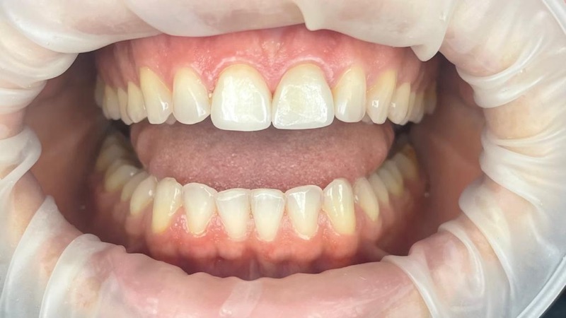 Before-and-after patient smile result at M Dental