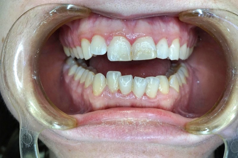 Before-and-after patient smile result at M Dental
