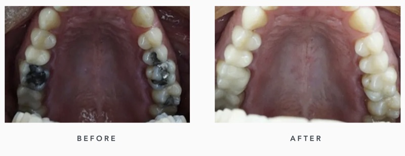 Before-and-after patient smile result at M Dental