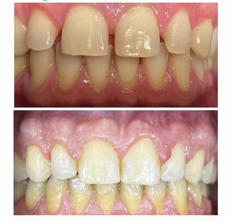Before-and-after patient smile result at M Dental