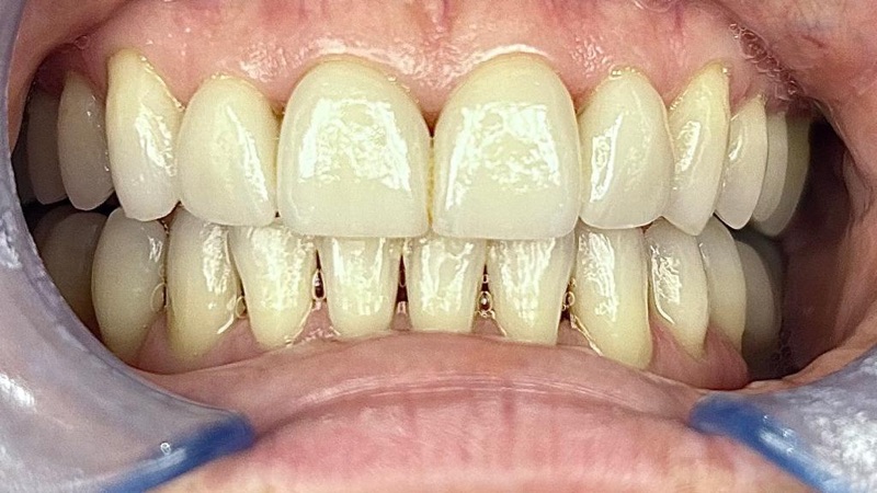 Before-and-after patient smile result at M Dental