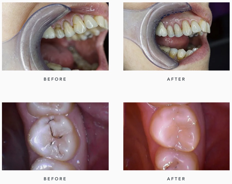 Before-and-after patient smile result at M Dental