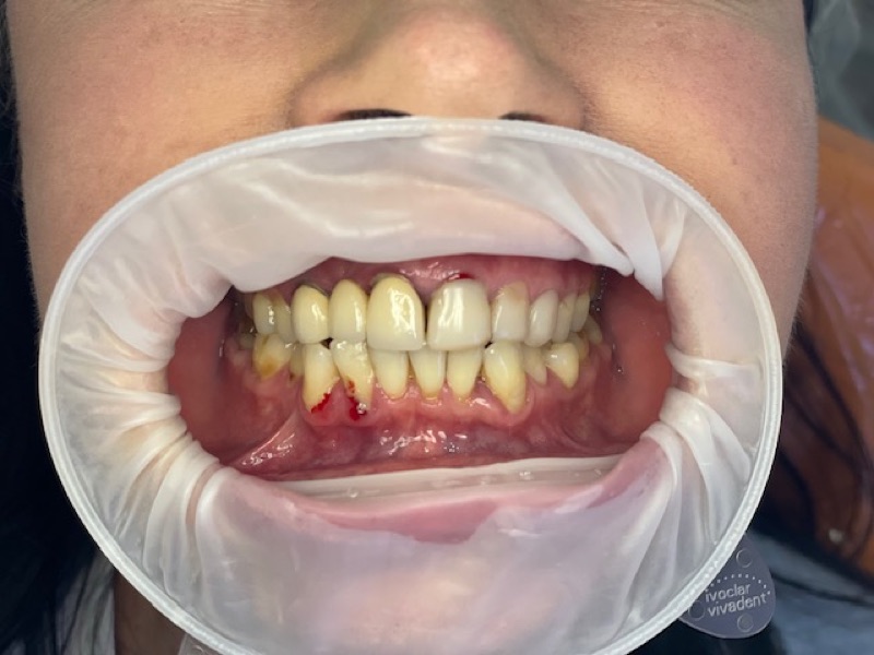 Before-and-after patient smile result at M Dental