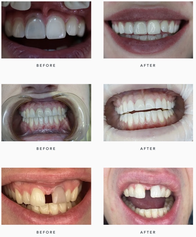 Before-and-after patient smile result at M Dental