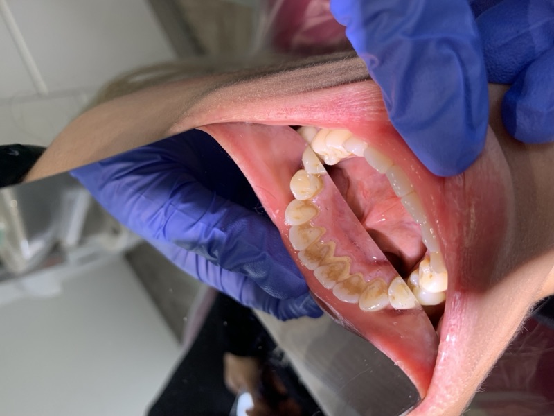Before-and-after patient smile result at M Dental