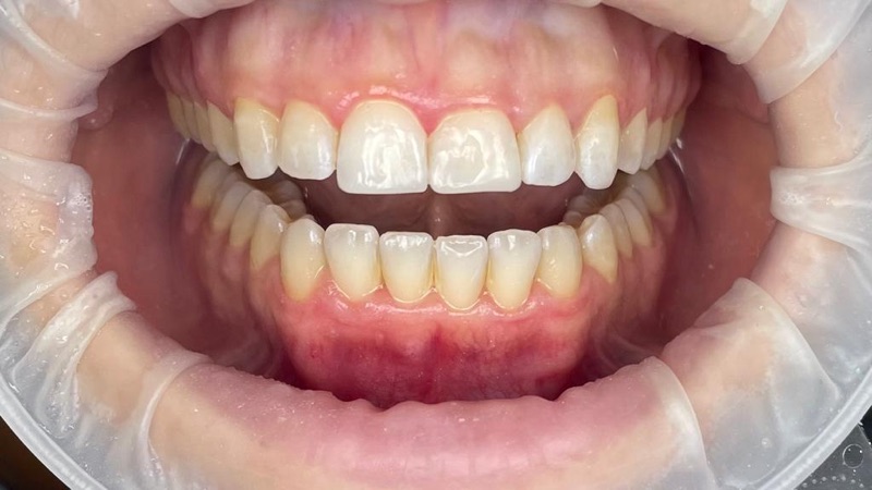 Before-and-after patient smile result at M Dental