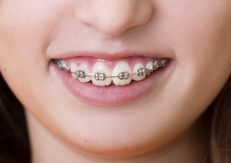 Fixed Braces at M Dental Canada Water, SE16