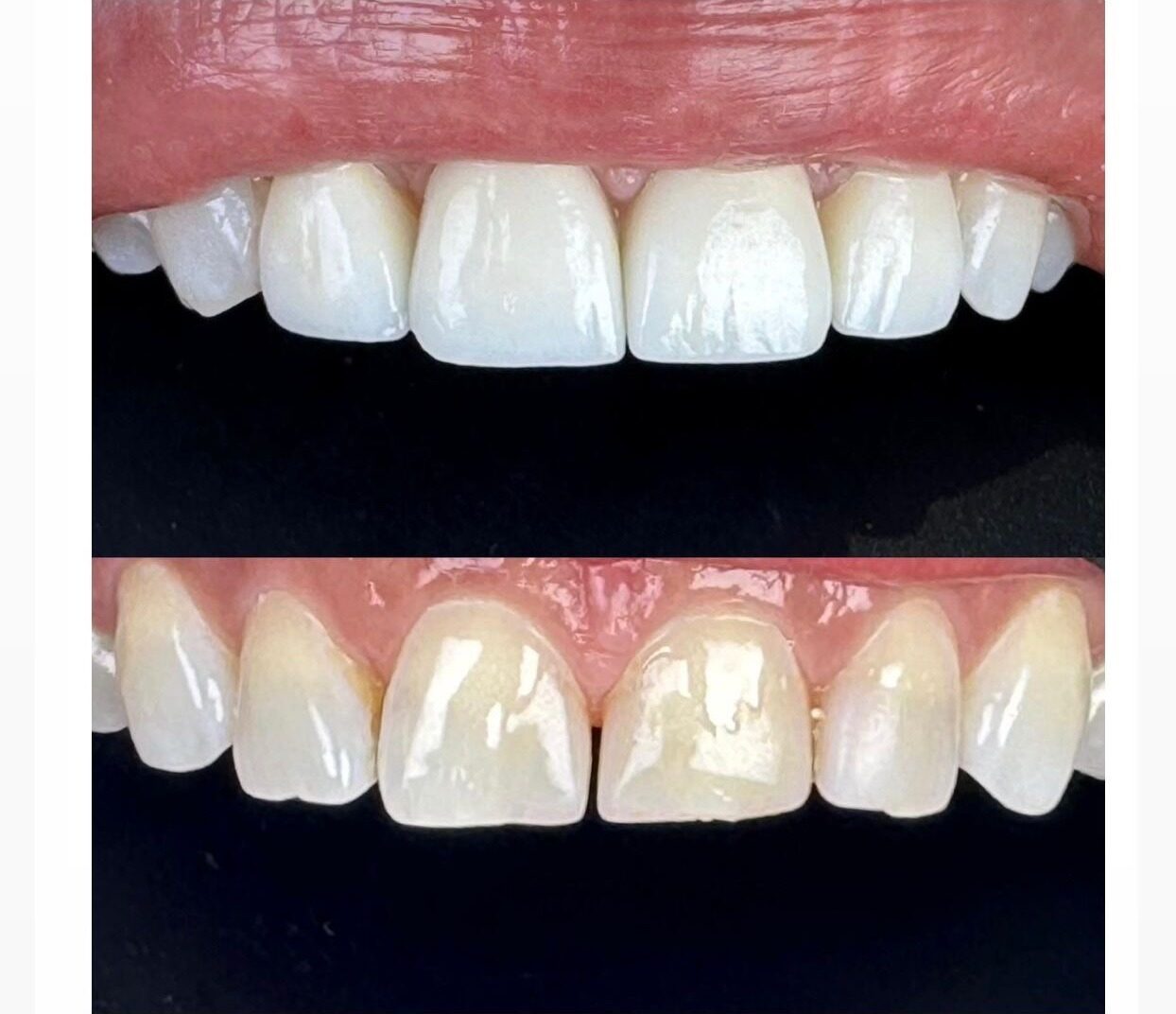 Veneers before and after result at M Dental