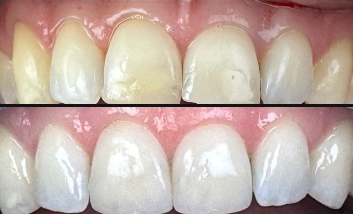 Veneers before and after result at M Dental