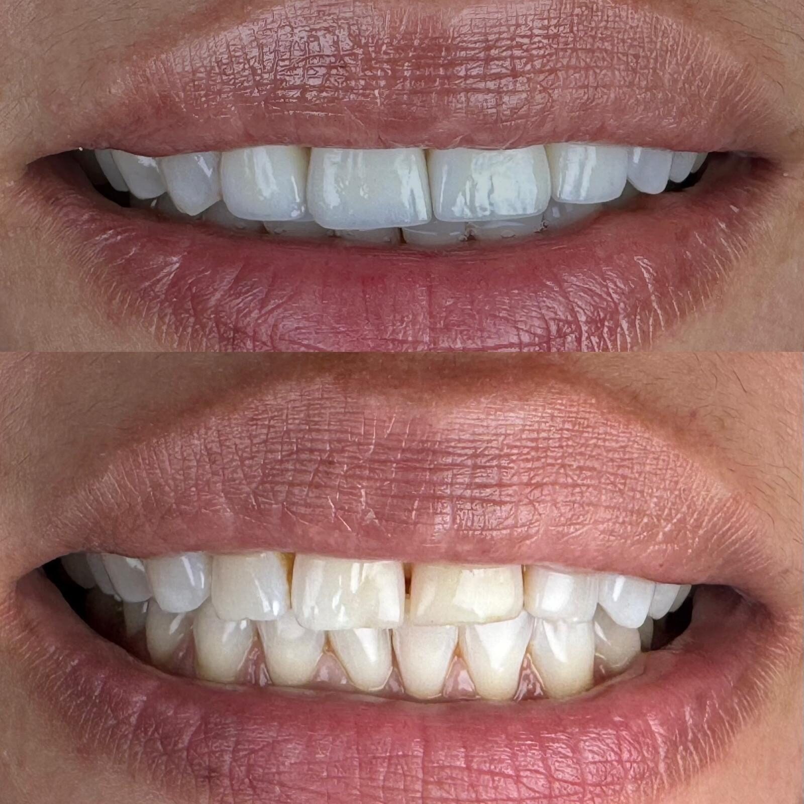 Veneers before and after result at M Dental
